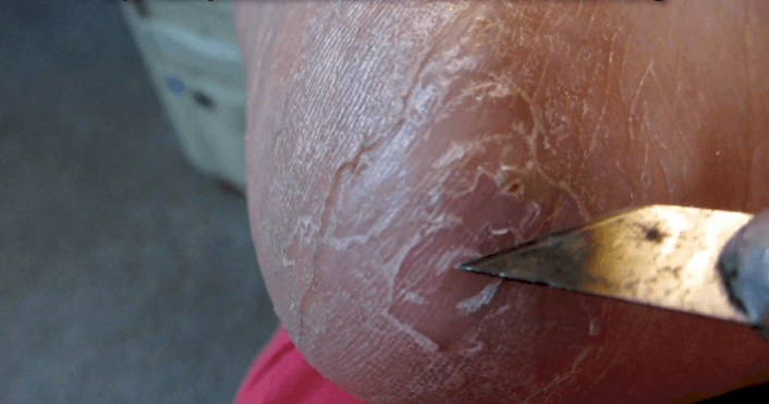 Image credit: Youtube/HEALTHY SMOOTH FEET Image credit: Youtube/HEALTHY SMOOTH FEET